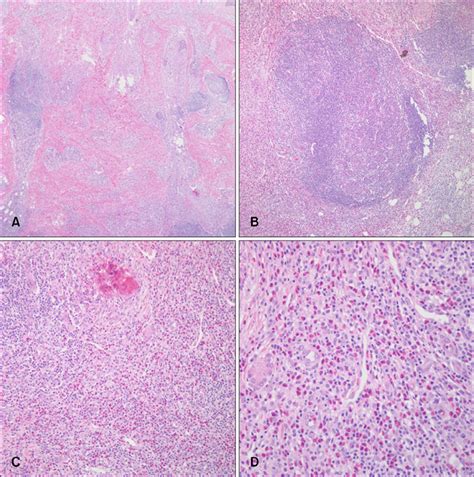 An Unusual Clinical Presentation Of Kimuras Disease Occurring On The
