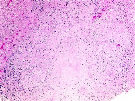 Granuloma Sarcoidosis Neqap245 1 Granulomatous Hepatit Flickr