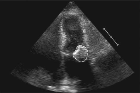 Caseous Calcification Of The Mitral Annulus A Review Elgendy 2013