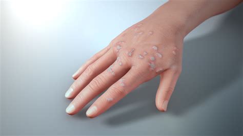 Common Hand Warts Scientific Animations