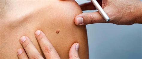 The Top 5 Signs Its Time To Find A Dermatologist Us Dermatology