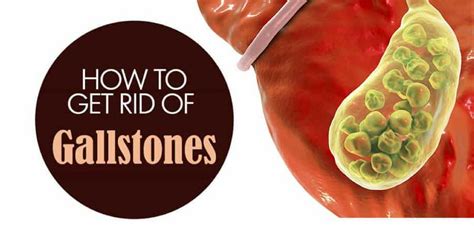 How Do You Get Stones In Your Gallbladder Gallstones Types Treatment Causes Diet Symptoms