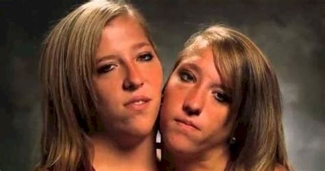 20 Interesting Things About Famous Conjoined Twins Abby