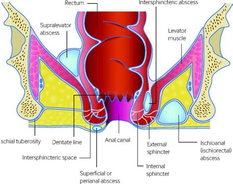 Perianal Abscess Causes Signs Symptoms Diagnosis Prognosis And Treatment