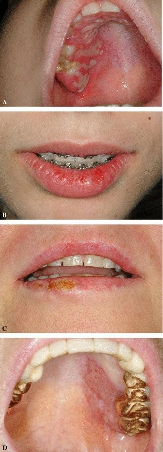 It may result in small blisters in groups often called cold sores or fever blisters or may just. Examples of clinical manifestation of Herpes Simplex Virus ...