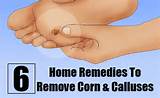 Pictures of Home Remedies Corn Removal