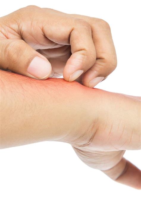 You may need a prescription treatment. Nickel allergy: Symptoms, treatment, and what to avoid