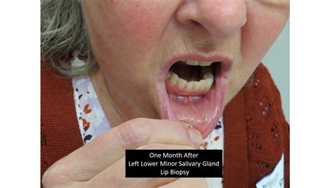 Sequence Of Healing After Lip Biopsy For Sjogren S Syndrome Minor Salivary Gland Biopsy Iowa