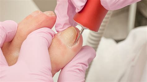 Ingrown Nail Surgery The Podiatry Experts