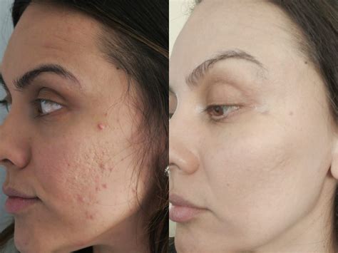 How I Got Rid Of My Acne Scars From Home Amberxo
