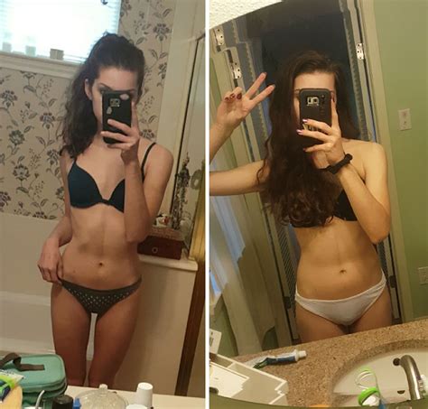 10 Before After Pics Of People Who Defeated Anorexia Bored Panda