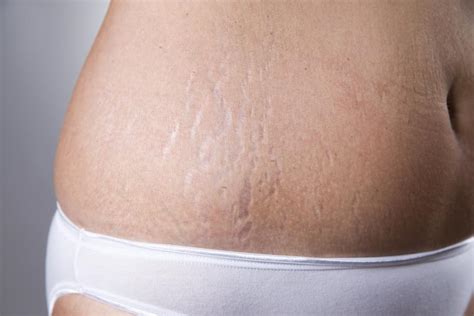 Stretch Marks Causes And Treatments