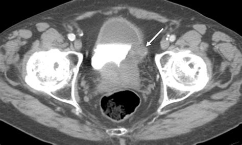 Axial Ct Urogram Excretory Phase Images Show A Lobulated Mass Along The