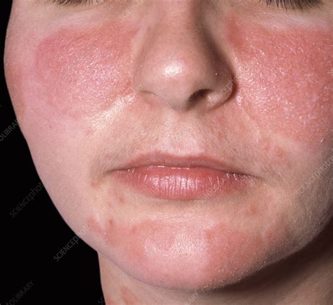Seborrheic Dermatitis Stock Image C Science Photo Library 58653 Hot