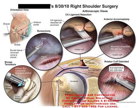 The spectrum of lhbt injuries includes primary and secondary tendinitis, chronic tendinopathy, superior labrum anterior and posterior (slap) lesions, instability, and partial or complete ruptures. Cas, Portal and Muscle on Pinterest