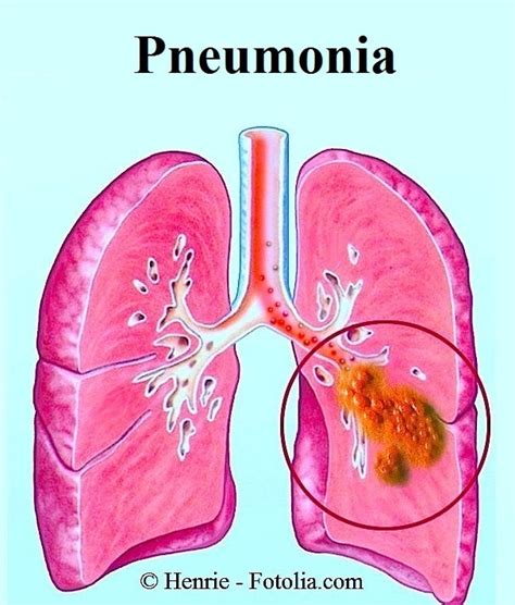 Sintomas De Pneumonia Viral E Tratamento