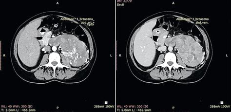 Abdomen Ct Left Adrenal Gland Tumor Infiltration Of Left Renal Vein
