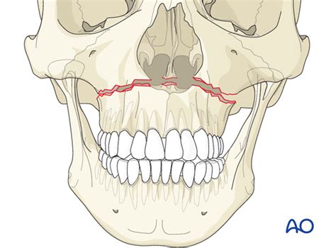 Maxilla Upper Jaw Rancho Santa Margarita Ca Orange County Surgical