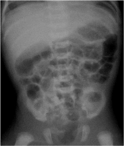 Preoperative Plain Abdominal Radiograph Showing Normal Bowel Pattern