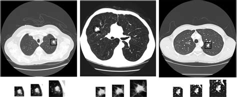 Ct Examples With Lung Nodules In Different Categories They Are Benign