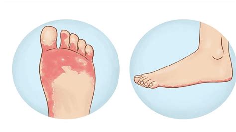 How To Get Rid Of Athletes Foot With Apple Cider Vinegar Youtube