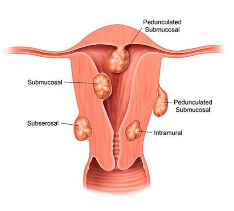 Understanding Uterine Fibroid Size How Big Is Too Big