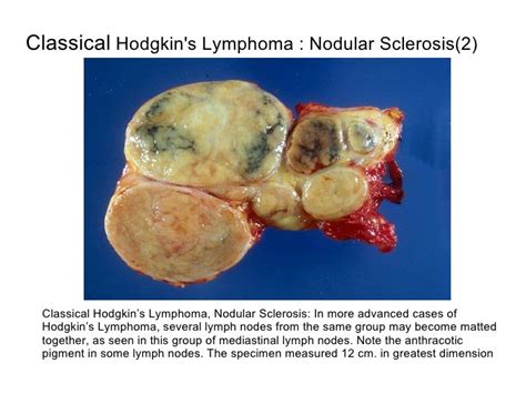 Hodgkins Lymphoma