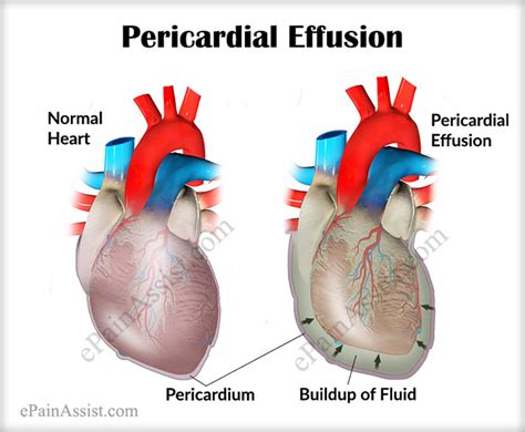 What Is Pericardial Effusion Images And Photos Finder