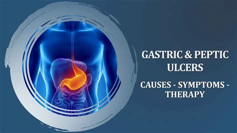 Gastric And Peptic Ulcers Causes Symptoms Therapy Youtube