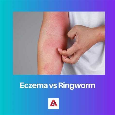 Difference Between Eczema And Ringworm