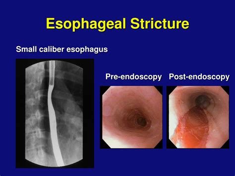 Ppt Eosinophilic Gastrointestinal Diseases Powerpoint Presentation