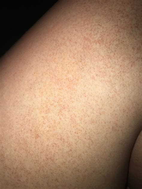 What Are These Tiny Brownred Spots On My Legs 21f Medicaladvice