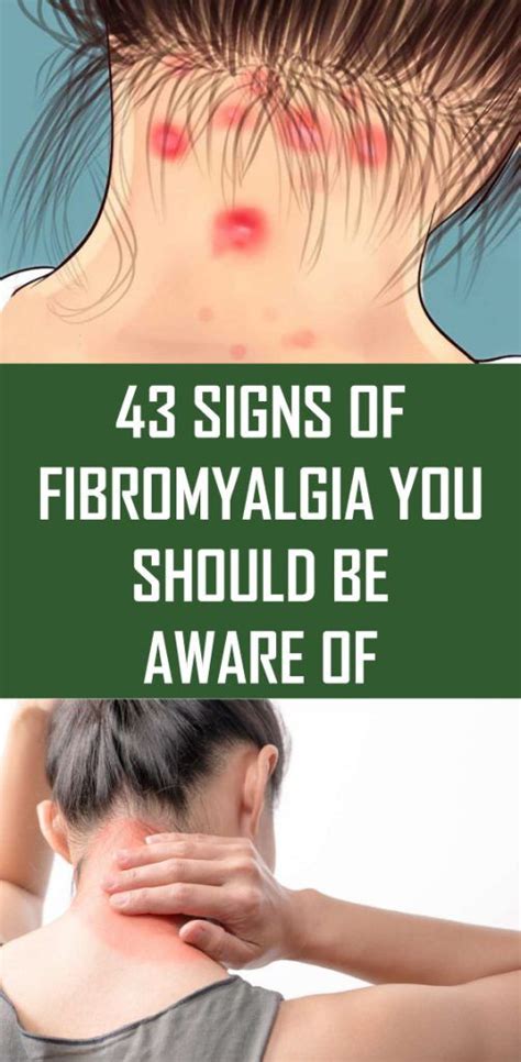 43 Signs Of Fibromyalgia You Should Be Aware Of Signs Of Fibromyalgia