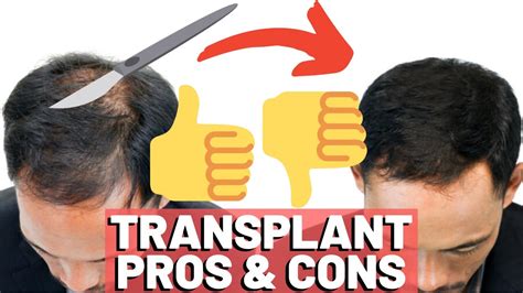 Hair Transplant PROS CONS YouTube