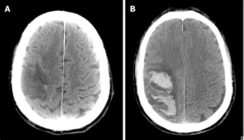 Hemorrhagic Transformation After Acute Ischemic Stroke Caused By