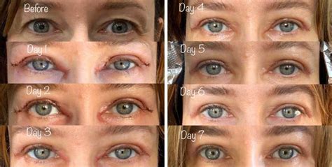 Upper Blepharoplasty Before And After Gallery Taban Md