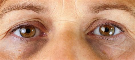 Do Allergies Cause Dark Circles Under Your Eyes Allergies And Health