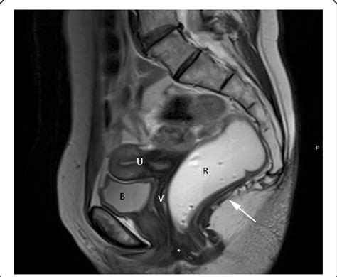 Normal Female Pelvic Anatomy Sagittal Midline T2 Tse Image
