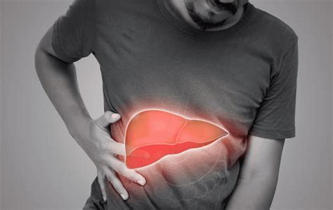 Karaciğer Sirozu Nedenleri Belirtileri ve Tedavisi