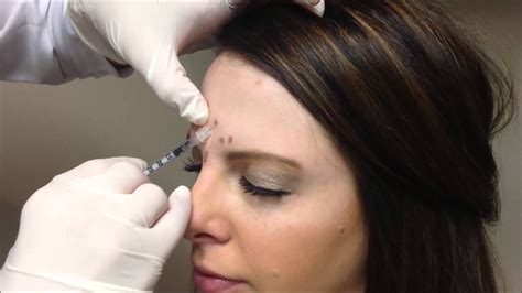 Allergan Botox Injections Youtube