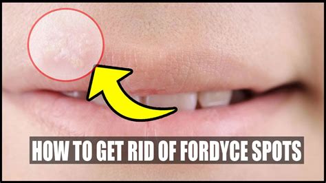 How To Get Rid Of Fordyce Spots On Lips With Home Remedies Small