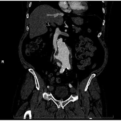 CT Angiography Acute Aortic Aneurysm With Aortocaval Fistula