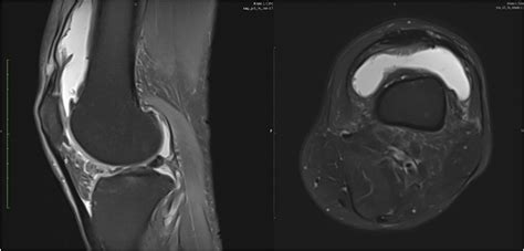 Swelling Assessment After Total Knee Arthroplasty Li Ka Yau Fu Henry
