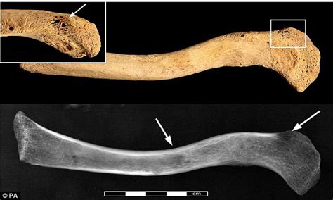 Archaeologists Find 3200 Year Old Skeleton With Cancer Daily Mail Online