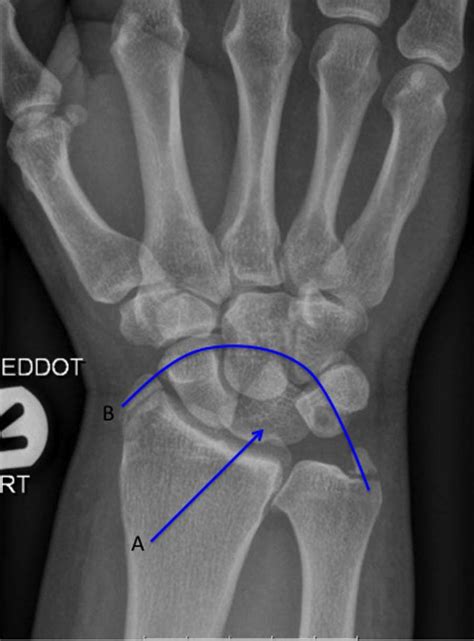 Annotated Ap View Of The Wrist The Piece Of Pie Classical Triangular