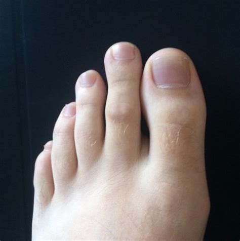 Discoveries Toe Alignment Meaning What Do Your Toes Really Say About