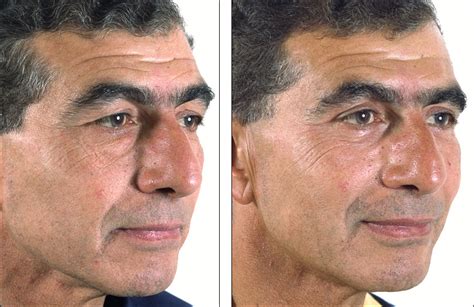 Dr Steven Denenbergs Facial Plastic Surgery Before And Afters Eyelid