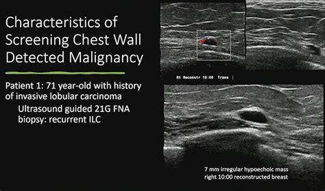 Chest Wall Ultrasound Good Alternative After Mastectomy