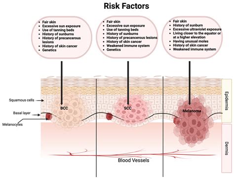 Risk Factors For The Most Common Types Of Skin Cancer Bcc Basal Cell