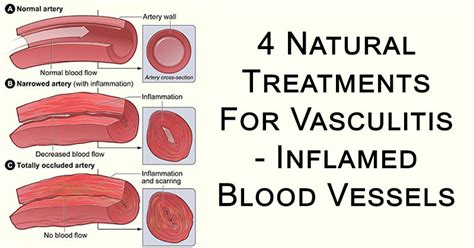 4 Natural Treatments For Vasculitis Inflamed Blood Vessels